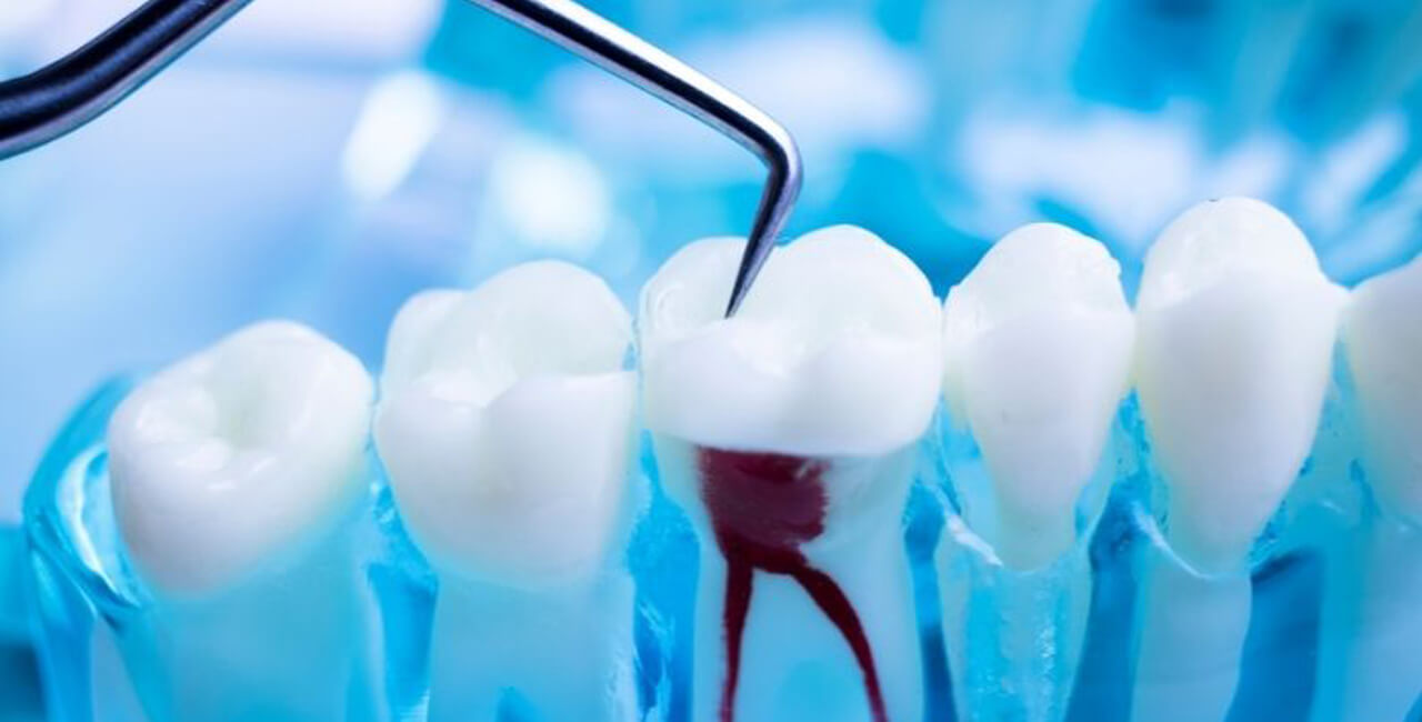 Overview Of Endodontics - B SPLASH